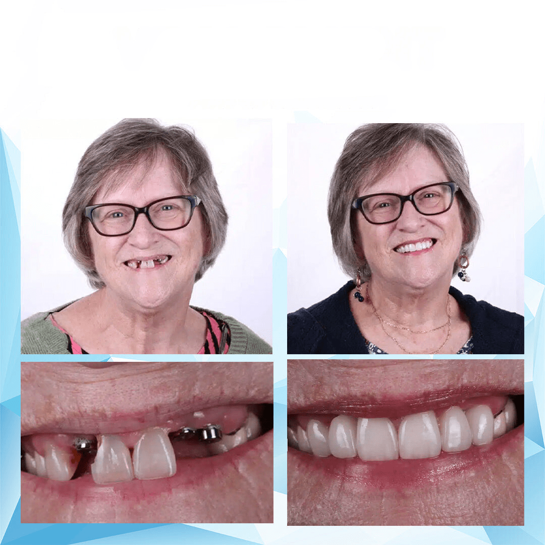 Denture Adhesive Perfect Fit Reline Kit Secure Hold - Oracle Gifts